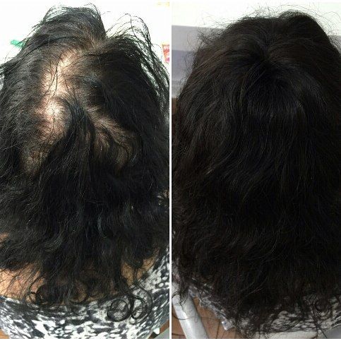 Aplique de cabelo para cobrir falhas